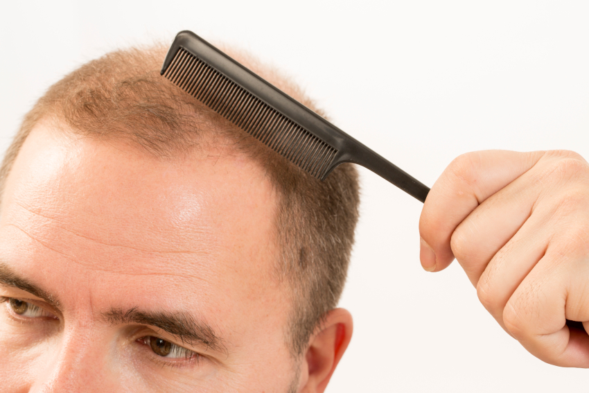 The Benefits of Getting a Hair Graft Procedure